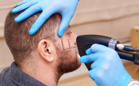 CO2 Laser Skin Resurfacing for Men Service