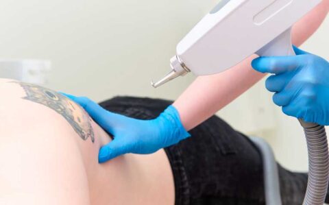 Laser Tattoo Removal Service