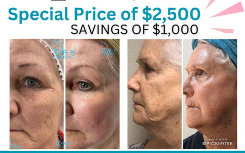 CO2 Fractional Skin Resurfacing February Special Post