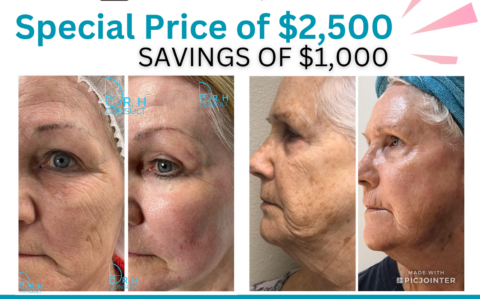 CO2 Fractional Skin Resurfacing February Special Post